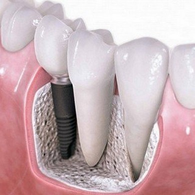 Имплантология в Уральске